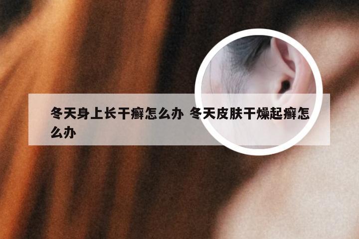 冬天身上长干癣怎么办 冬天皮肤干燥起癣怎么办