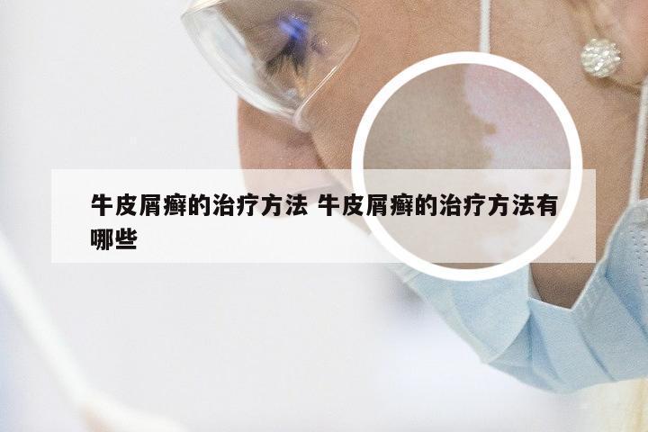 牛皮屑癣的治疗方法 牛皮屑癣的治疗方法有哪些