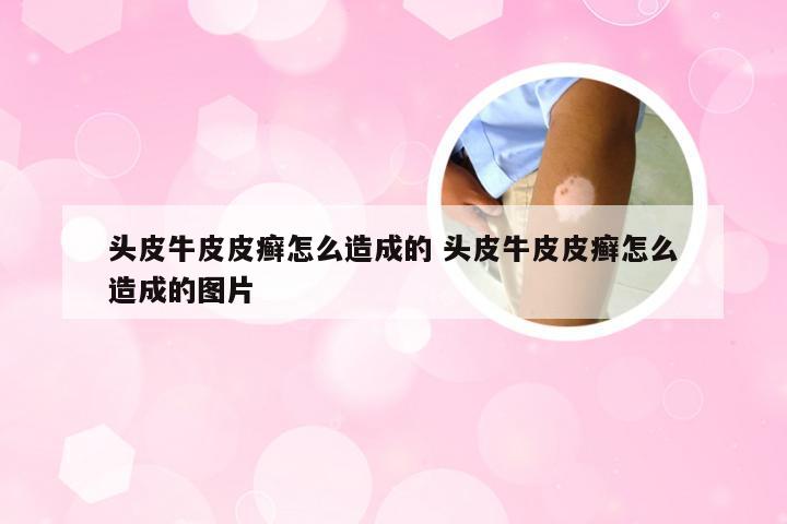 头皮牛皮皮癣怎么造成的 头皮牛皮皮癣怎么造成的图片