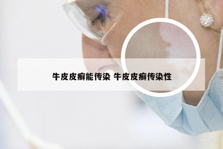 牛皮皮癣能传染 牛皮皮癣传染性