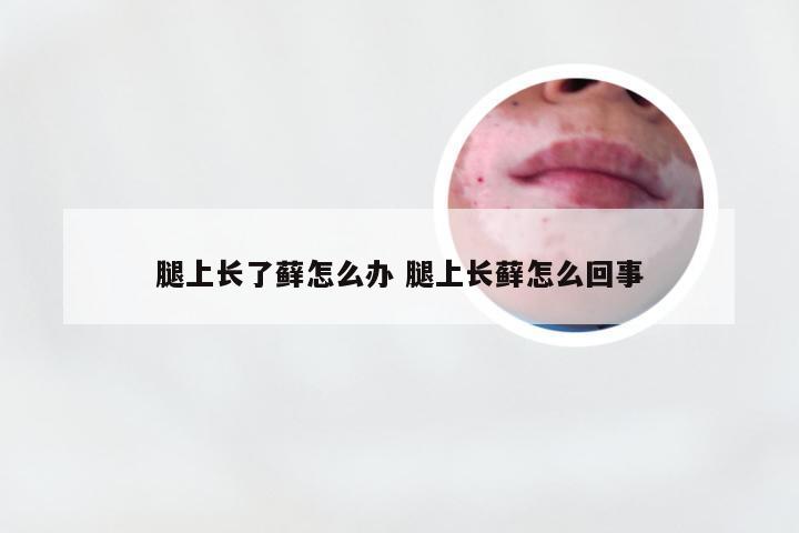 腿上长了藓怎么办 腿上长藓怎么回事