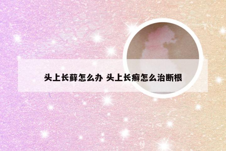 头上长藓怎么办 头上长癣怎么治断根