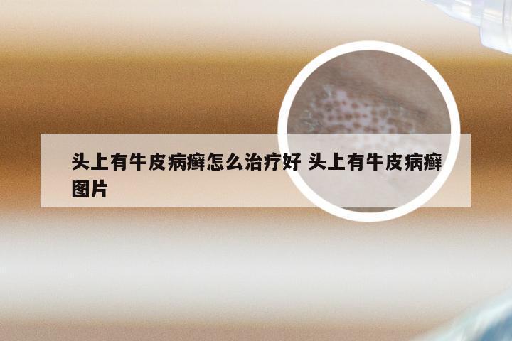 头上有牛皮病癣怎么治疗好 头上有牛皮病癣图片