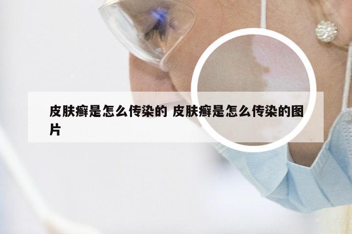 皮肤癣是怎么传染的 皮肤癣是怎么传染的图片