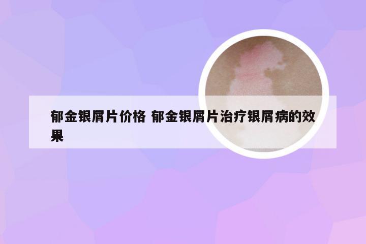 郁金银屑片价格 郁金银屑片治疗银屑病的效果