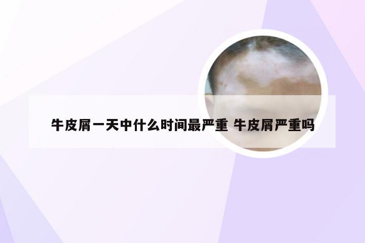 牛皮屑一天中什么时间最严重 牛皮屑严重吗