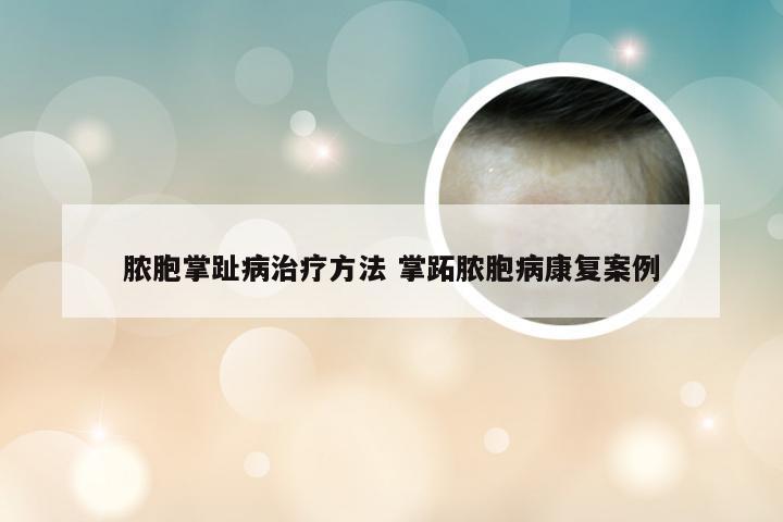 脓胞掌趾病治疗方法 掌跖脓胞病康复案例
