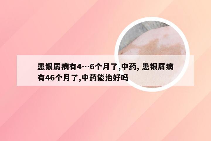 患银屑病有4…6个月了,中药, 患银屑病有46个月了,中药能治好吗