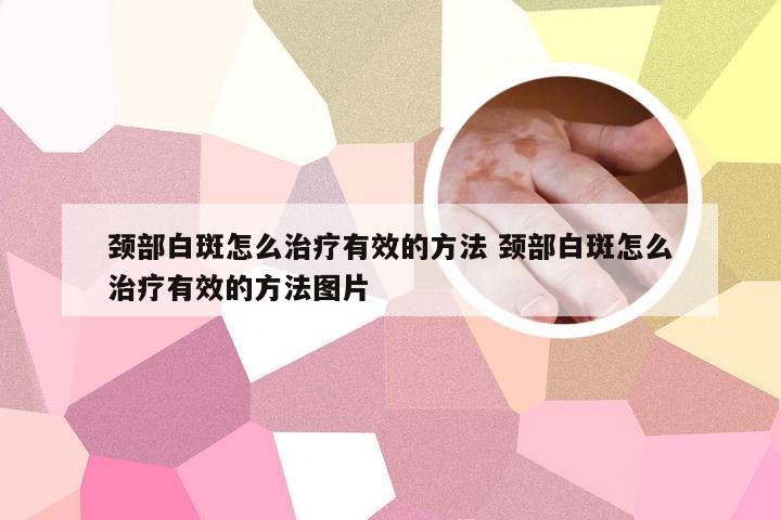 颈部白斑怎么治疗有效的方法 颈部白斑怎么治疗有效的方法图片