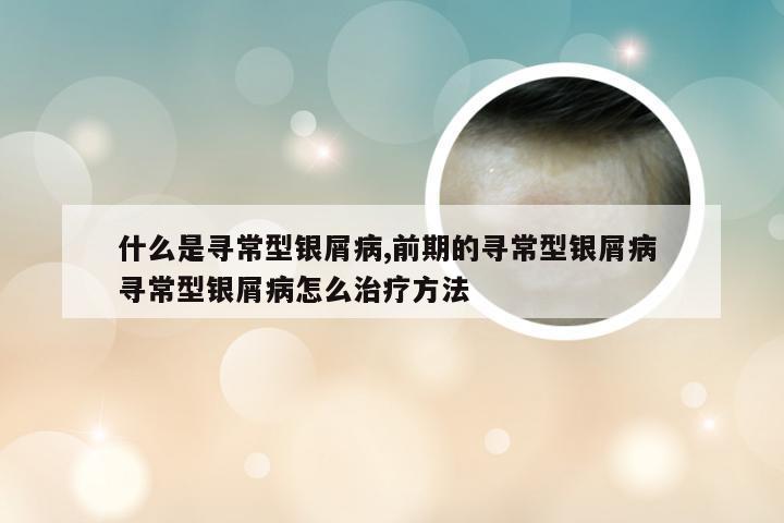 什么是寻常型银屑病,前期的寻常型银屑病 寻常型银屑病怎么治疗方法