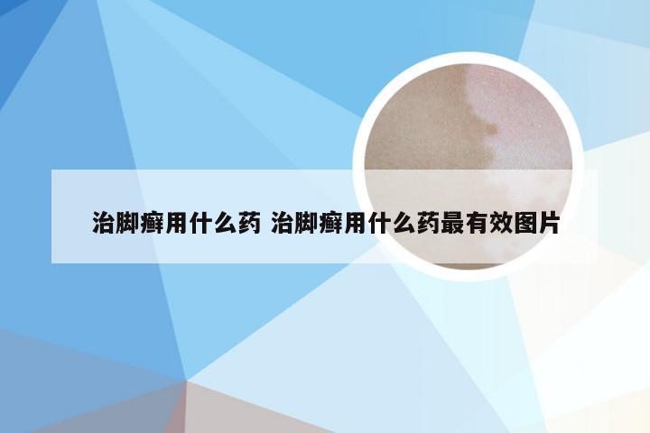 治脚癣用什么药 治脚癣用什么药最有效图片