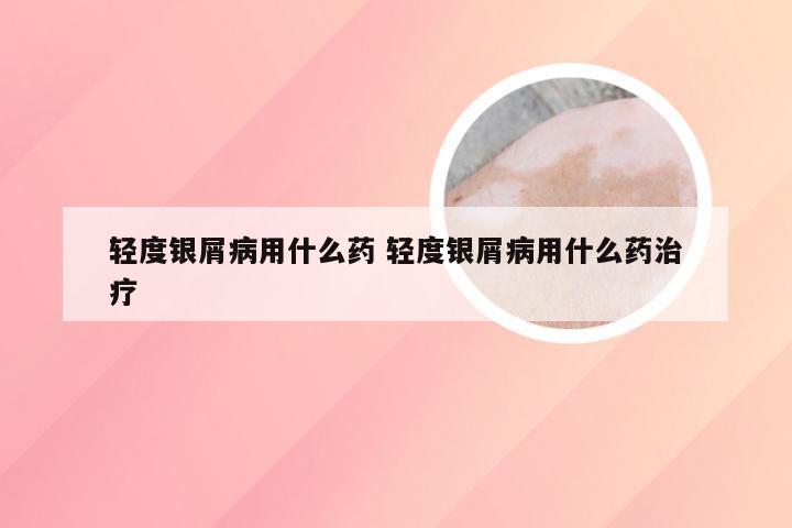 轻度银屑病用什么药 轻度银屑病用什么药治疗
