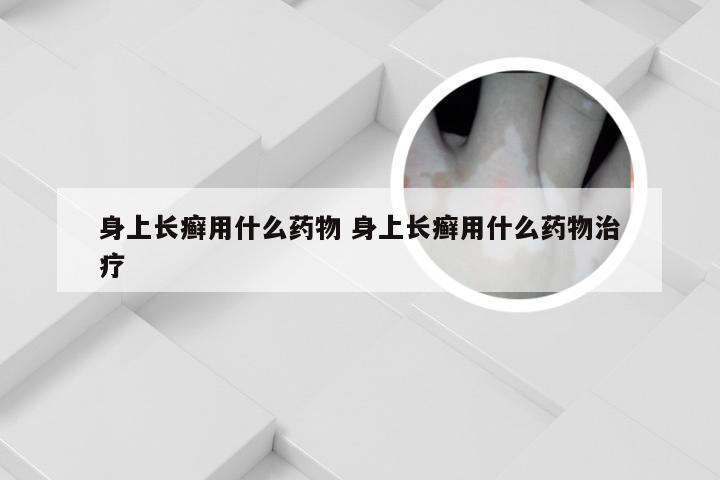 身上长癣用什么药物 身上长癣用什么药物治疗