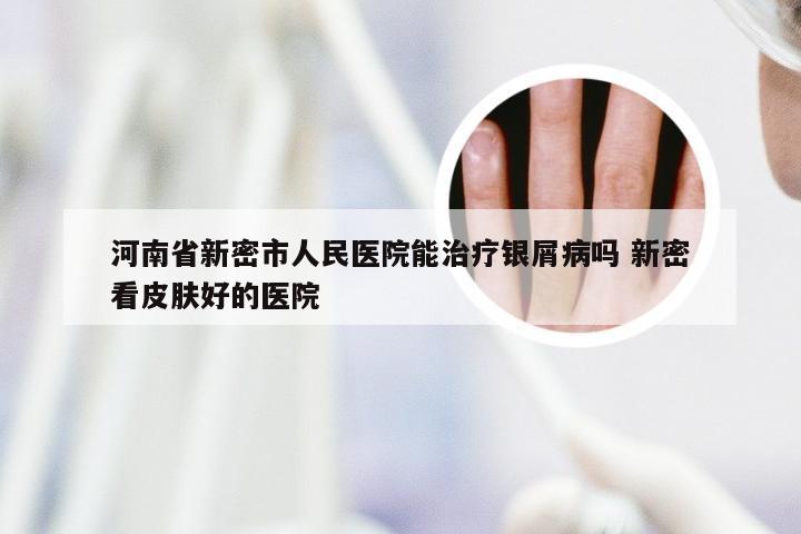 河南省新密市人民医院能治疗银屑病吗 新密看皮肤好的医院