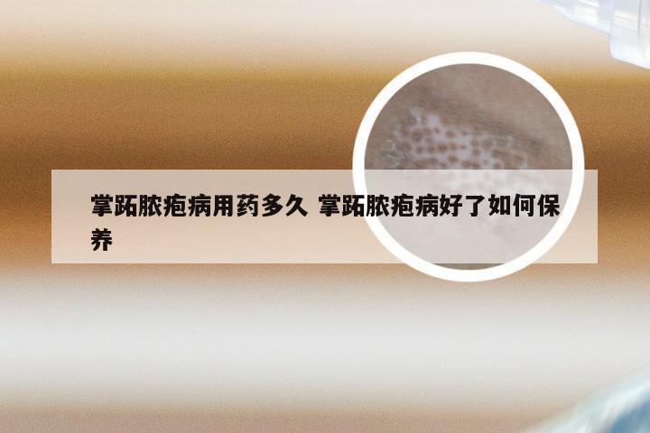 掌跖脓疱病用药多久 掌跖脓疱病好了如何保养
