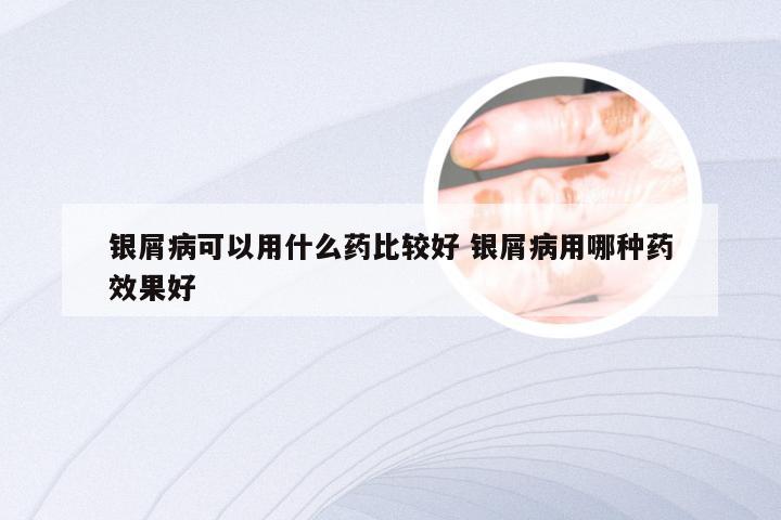 银屑病可以用什么药比较好 银屑病用哪种药效果好
