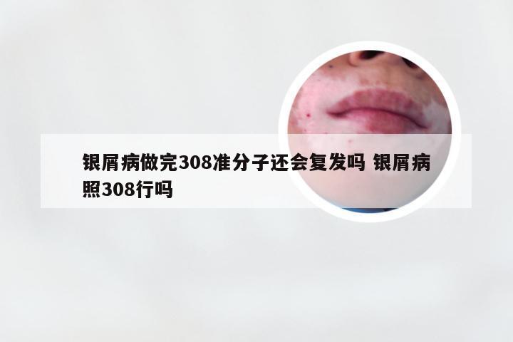 银屑病做完308准分子还会复发吗 银屑病照308行吗