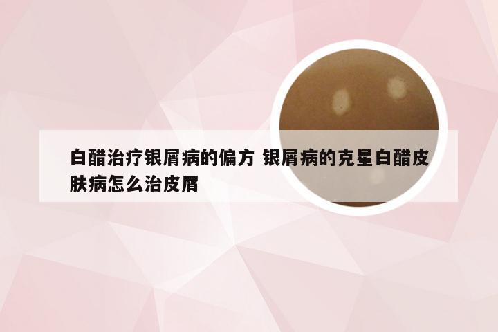 白醋治疗银屑病的偏方 银屑病的克星白醋皮肤病怎么治皮屑