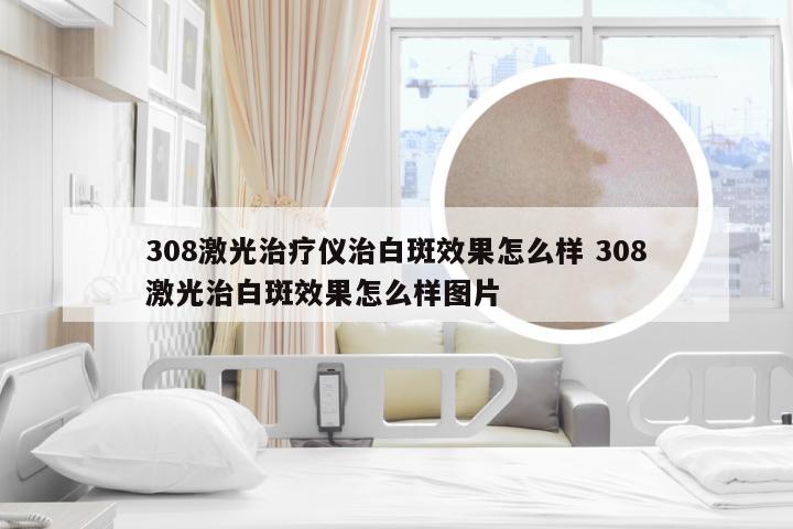 308激光治疗仪治白斑效果怎么样 308激光治白斑效果怎么样图片