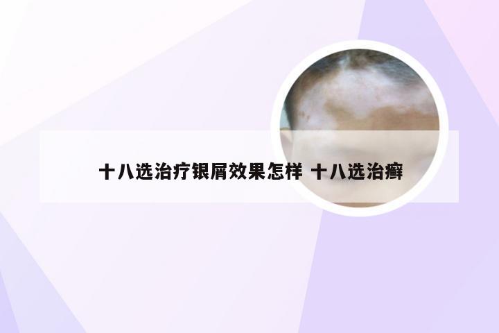 十八选治疗银屑效果怎样 十八选治癣