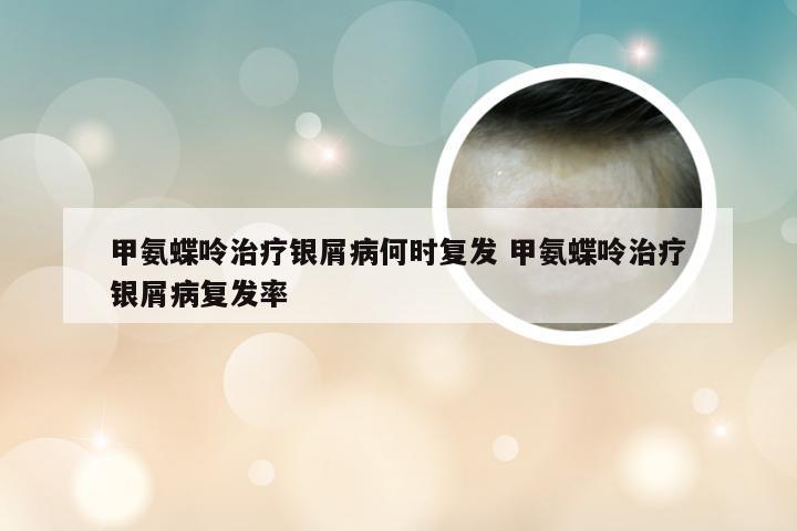 甲氨蝶呤治疗银屑病何时复发 甲氨蝶呤治疗银屑病复发率