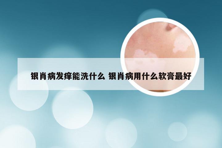银肖病发痒能洗什么 银肖病用什么软膏最好