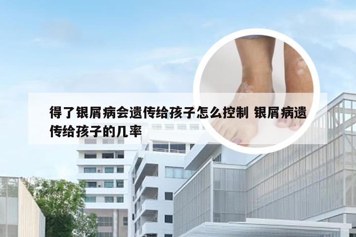 得了银屑病会遗传给孩子怎么控制 银屑病遗传给孩子的几率