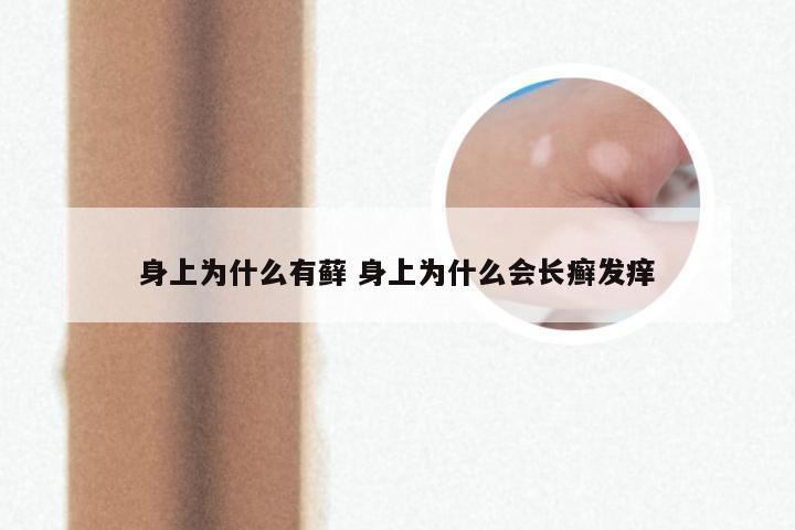 身上为什么有藓 身上为什么会长癣发痒