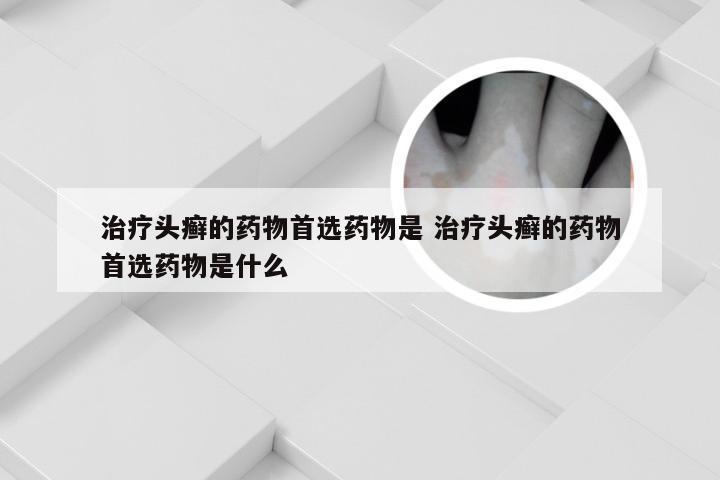 治疗头癣的药物首选药物是 治疗头癣的药物首选药物是什么