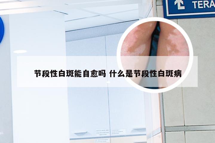 节段性白斑能自愈吗 什么是节段性白斑病