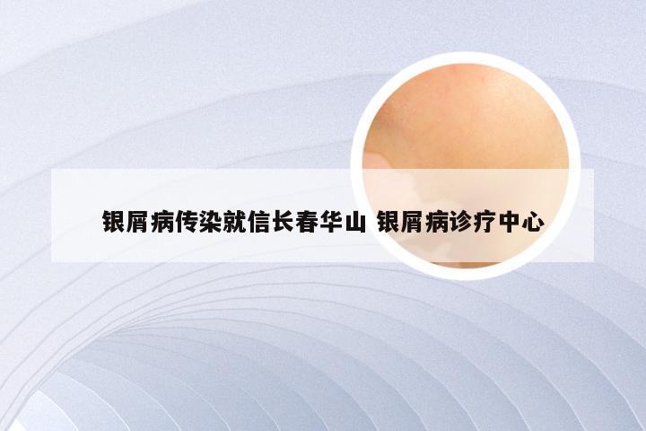 银屑病传染就信长春华山 银屑病诊疗中心
