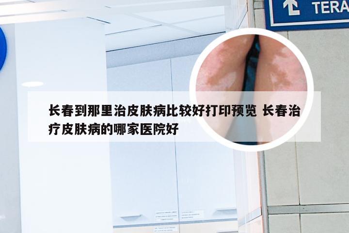 长春到那里治皮肤病比较好打印预览 长春治疗皮肤病的哪家医院好