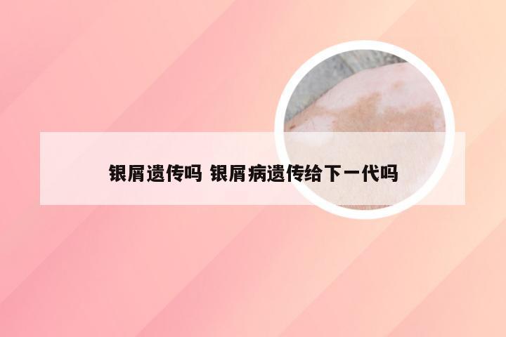 银屑遗传吗 银屑病遗传给下一代吗