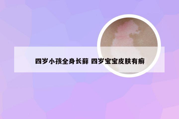 四岁小孩全身长藓 四岁宝宝皮肤有癣