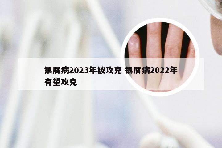 银屑病2023年被攻克 银屑病2022年有望攻克