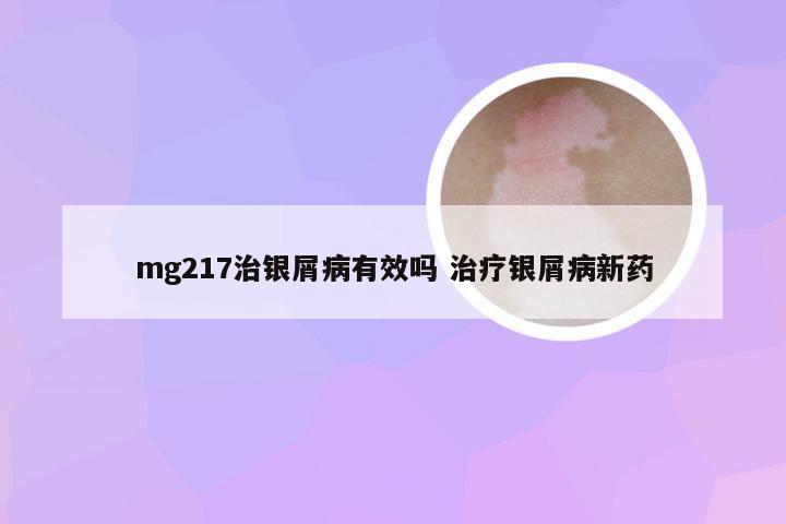 mg217治银屑病有效吗 治疗银屑病新药