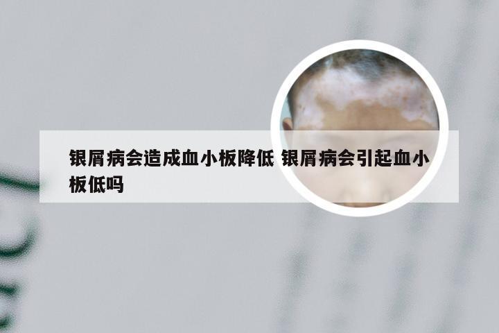 银屑病会造成血小板降低 银屑病会引起血小板低吗