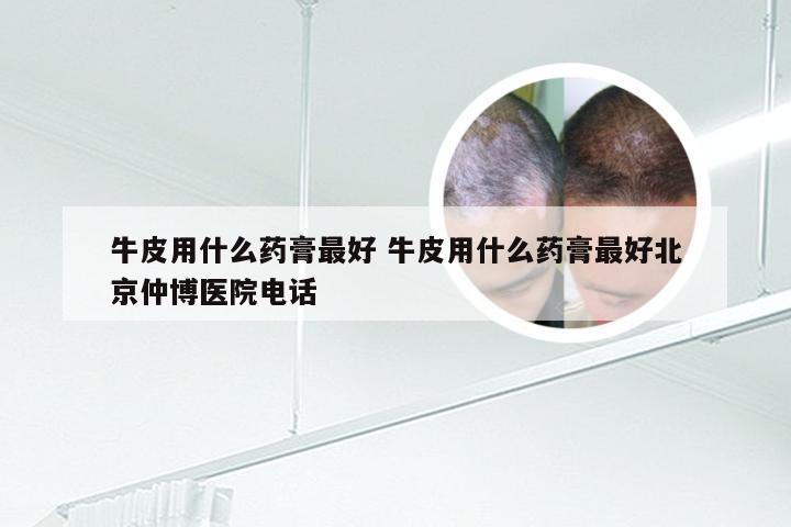 牛皮用什么药膏最好 牛皮用什么药膏最好北京仲博医院电话