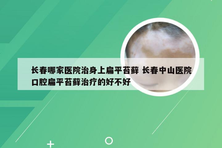 长春哪家医院治身上扁平苔藓 长春中山医院口腔扁平苔藓治疗的好不好