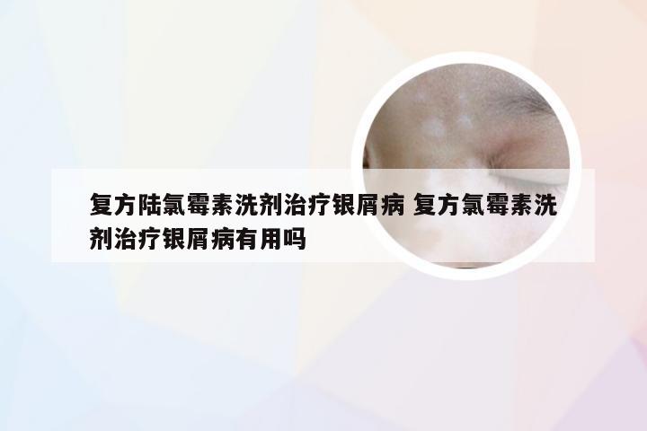 复方陆氯霉素洗剂治疗银屑病 复方氯霉素洗剂治疗银屑病有用吗