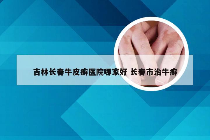 吉林长春牛皮癣医院哪家好 长春市治牛癣