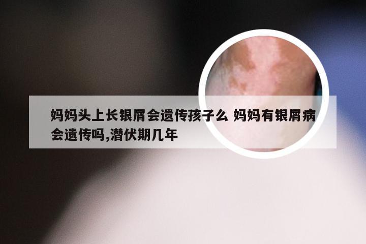 妈妈头上长银屑会遗传孩子么 妈妈有银屑病会遗传吗,潜伏期几年