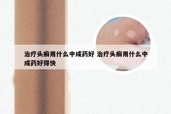 治疗头癣用什么中成药好 治疗头癣用什么中成药好得快