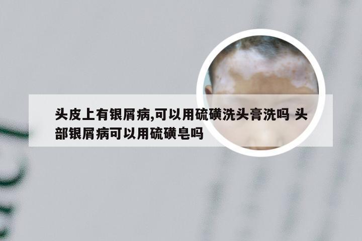 头皮上有银屑病,可以用硫磺洗头膏洗吗 头部银屑病可以用硫磺皂吗