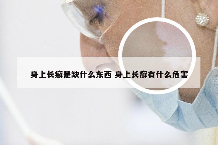 身上长癣是缺什么东西 身上长癣有什么危害