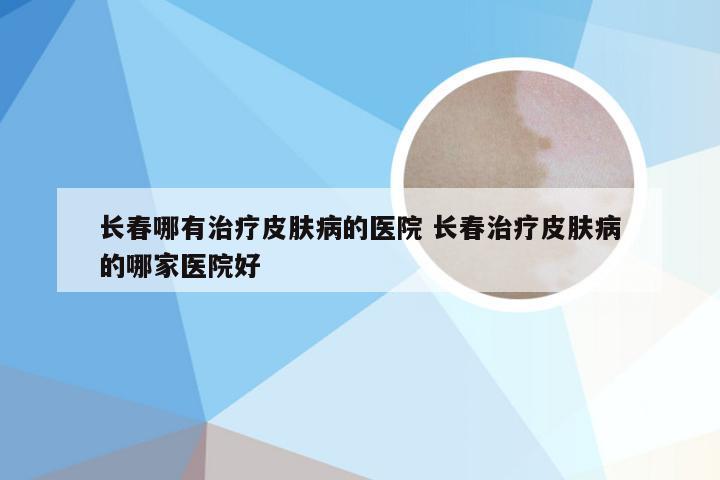 长春哪有治疗皮肤病的医院 长春治疗皮肤病的哪家医院好