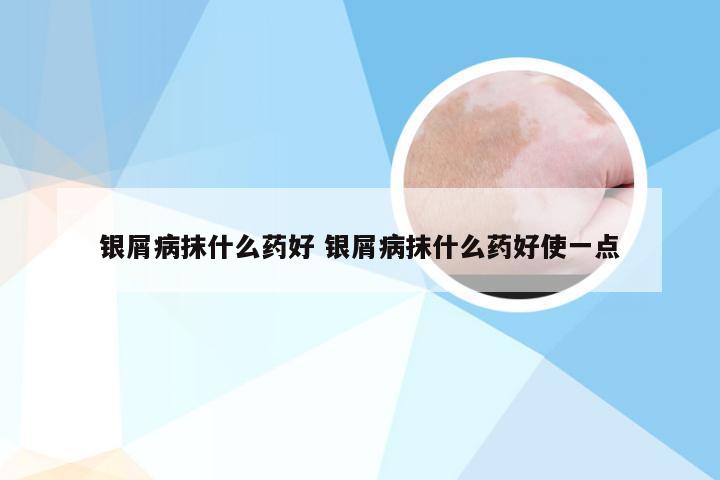 银屑病抹什么药好 银屑病抹什么药好使一点