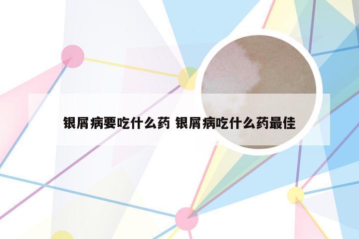 银屑病要吃什么药 银屑病吃什么药最佳