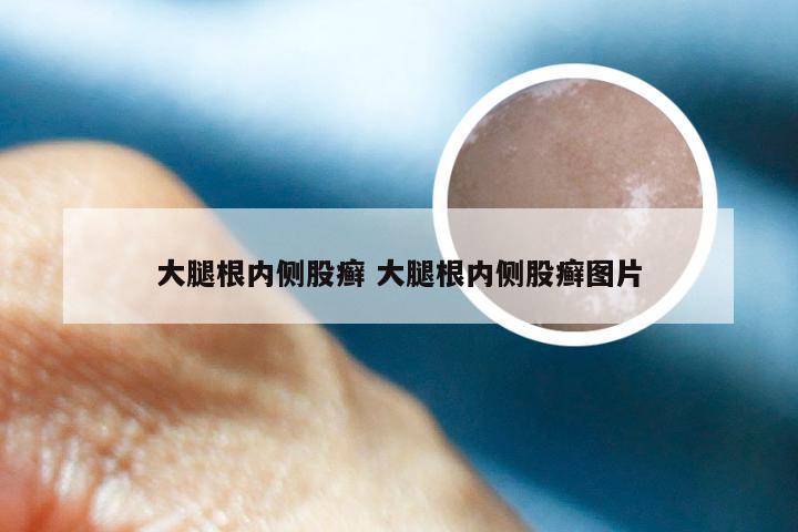 大腿根内侧股癣 大腿根内侧股癣图片