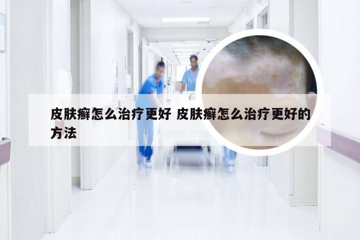 皮肤癣怎么治疗更好 皮肤癣怎么治疗更好的方法